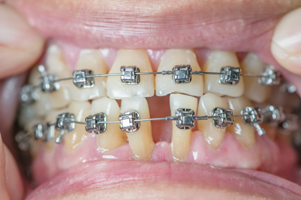 stained-teeth-after-braces