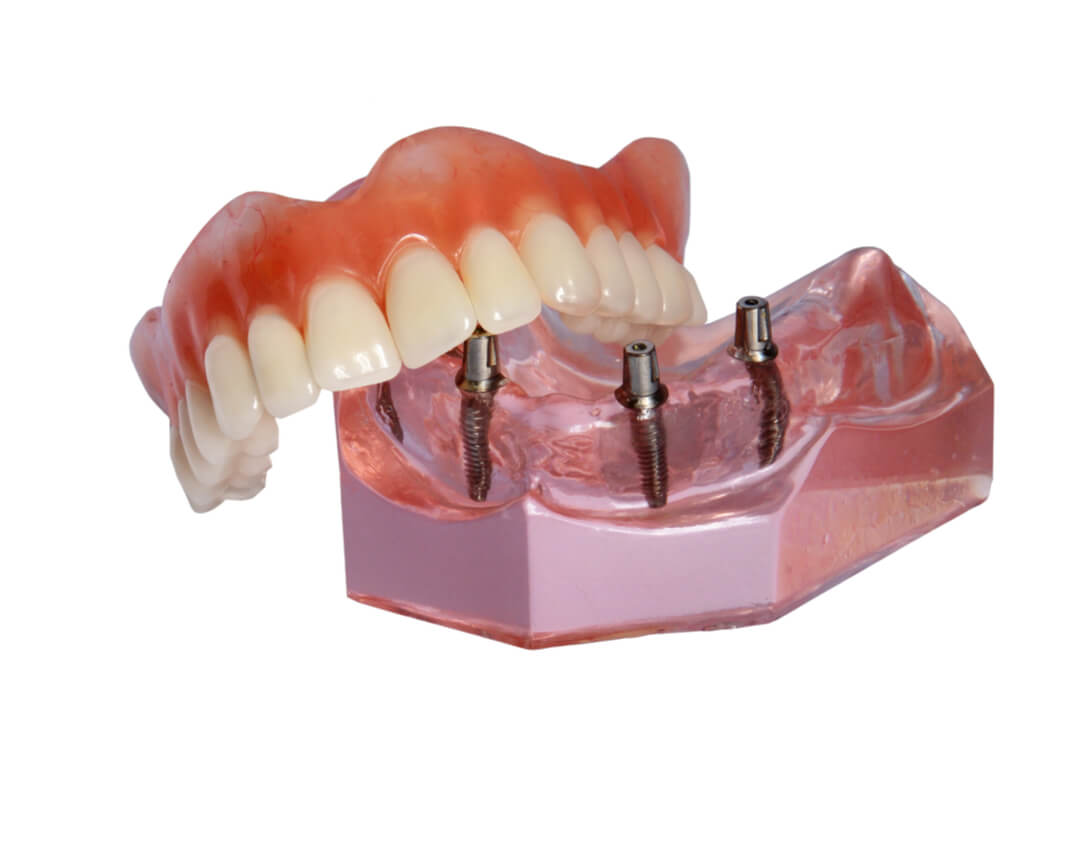 Getting Dentures or Dental Implants-What To Choose