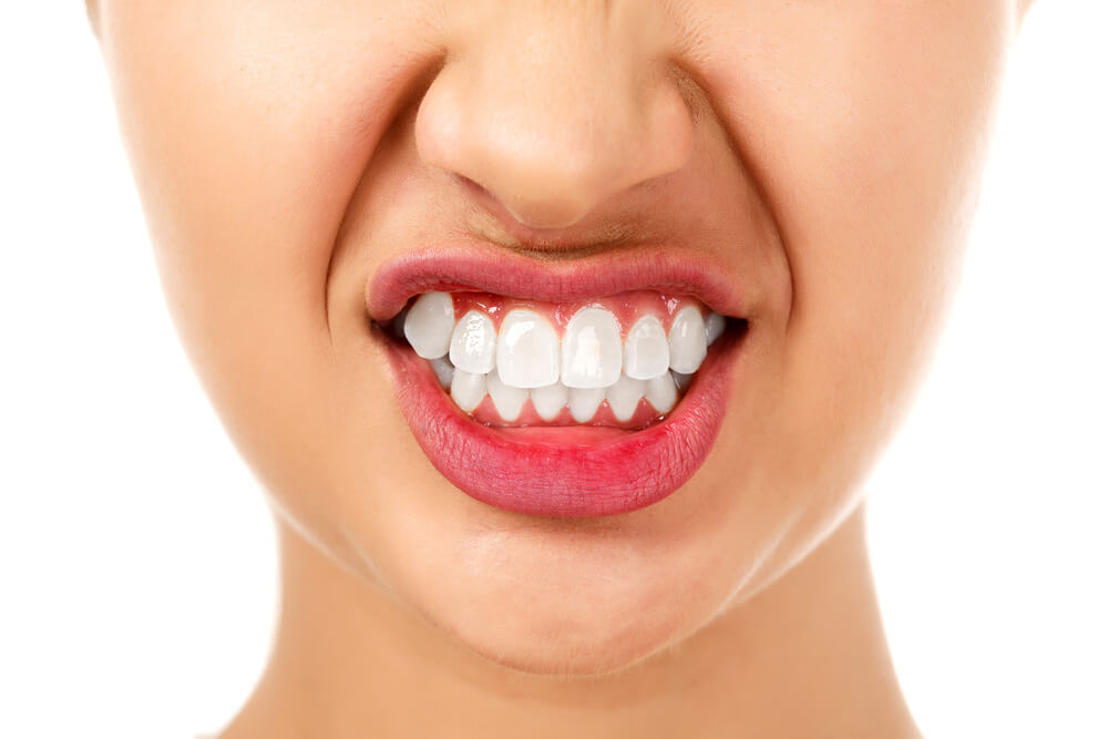 Bruxism – Stress and Teeth Grinding Problem