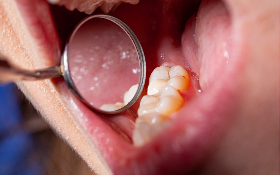 What Is A Temporary Dental Filling, What Is It Used For?