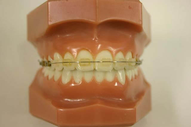 dental braces
