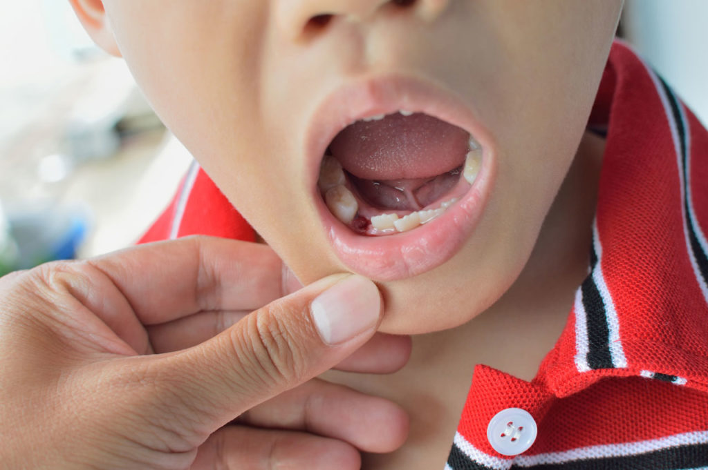 How To Prevent Dry Socket After Tooth Extraction