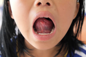 Tongue Bumps